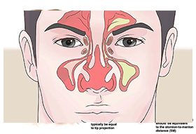 rhinoplastie2